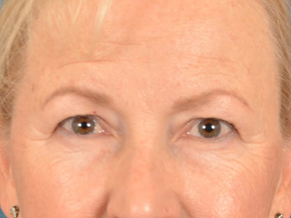 Eyelid Lift Before & After Gallery - Patient 970008 - Image 1