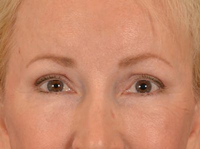 Brow Lift Before & After Gallery - Patient 102775 - Image 2