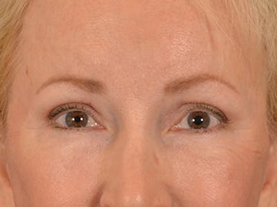 Eyelid Lift Before & After Gallery - Patient 970008 - Image 2