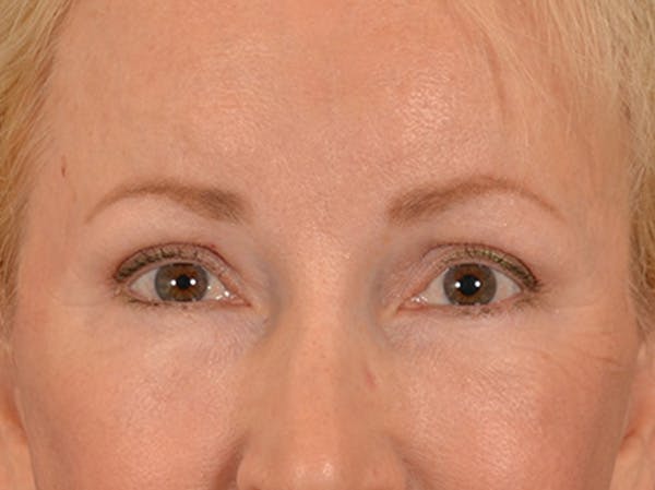 Brow Lift Before & After Gallery - Patient 102775 - Image 2