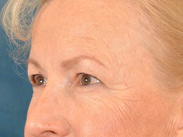 Brow Lift Before & After Gallery - Patient 102775 - Image 3