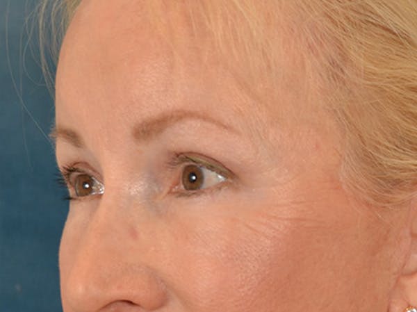 Brow Lift Before & After Gallery - Patient 102775 - Image 4