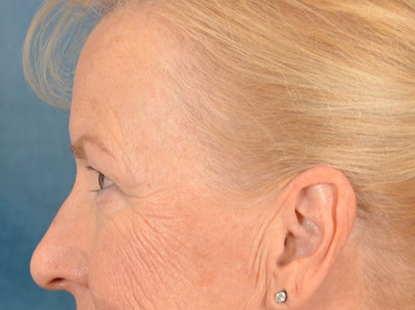 Brow Lift Before & After Gallery - Patient 102775 - Image 5