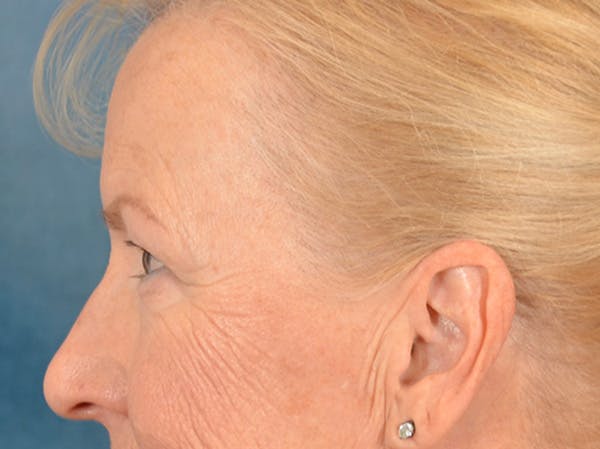 Eyelid Lift Before & After Gallery - Patient 970008 - Image 5