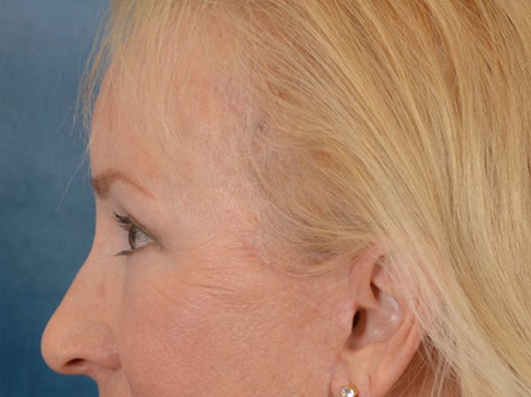 Brow Lift Before & After Gallery - Patient 102775 - Image 6