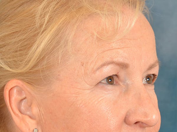 Brow Lift Before & After Gallery - Patient 102775 - Image 7