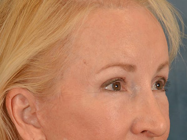 Brow Lift Before & After Gallery - Patient 102775 - Image 8
