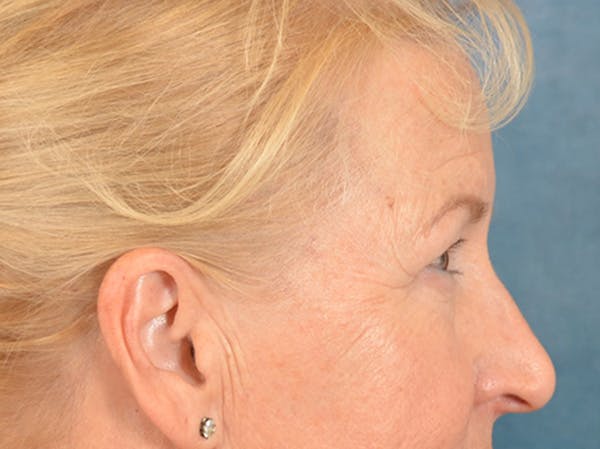 Eyelid Lift Before & After Gallery - Patient 970008 - Image 9