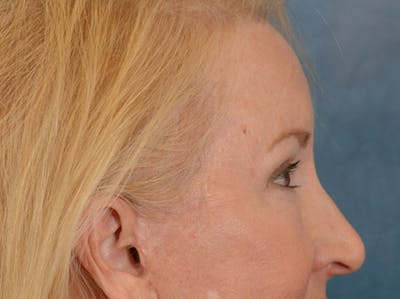 Brow Lift Before & After Gallery - Patient 102775 - Image 10
