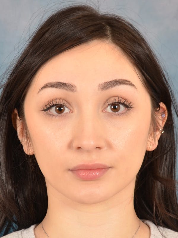 Rhinoplasty Before & After Gallery - Patient 286205 - Image 5