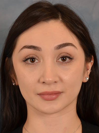 Rhinoplasty Before & After Gallery - Patient 286205 - Image 6