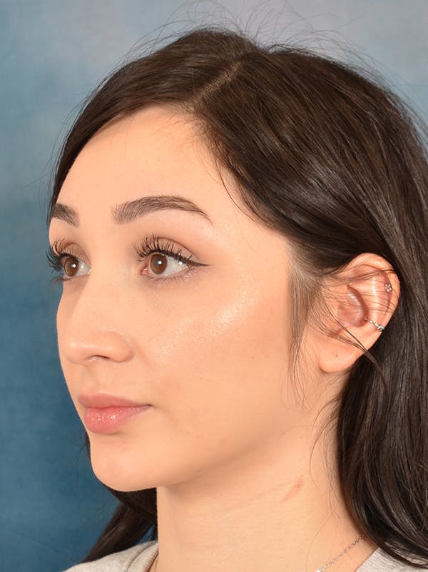 Rhinoplasty Before & After Gallery - Patient 286205 - Image 3