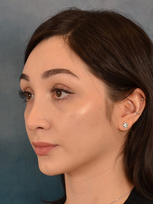 Rhinoplasty Before & After Gallery - Patient 286205 - Image 4