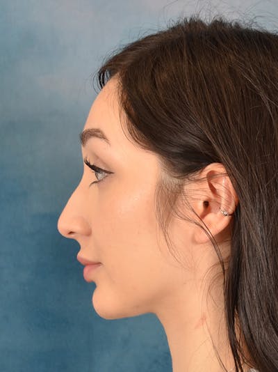 Rhinoplasty Before & After Gallery - Patient 286205 - Image 2