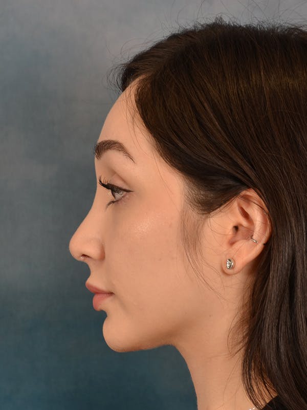 Rhinoplasty Before & After Gallery - Patient 286205 - Image 2
