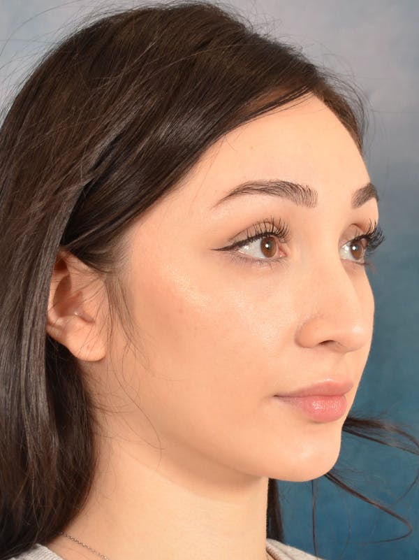 Rhinoplasty Before & After Gallery - Patient 286205 - Image 7
