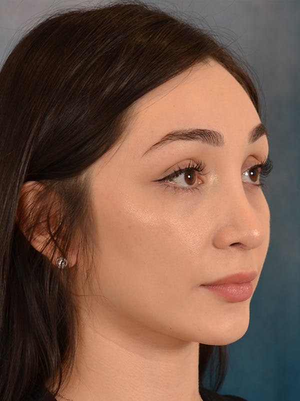 Rhinoplasty Before & After Gallery - Patient 286205 - Image 8