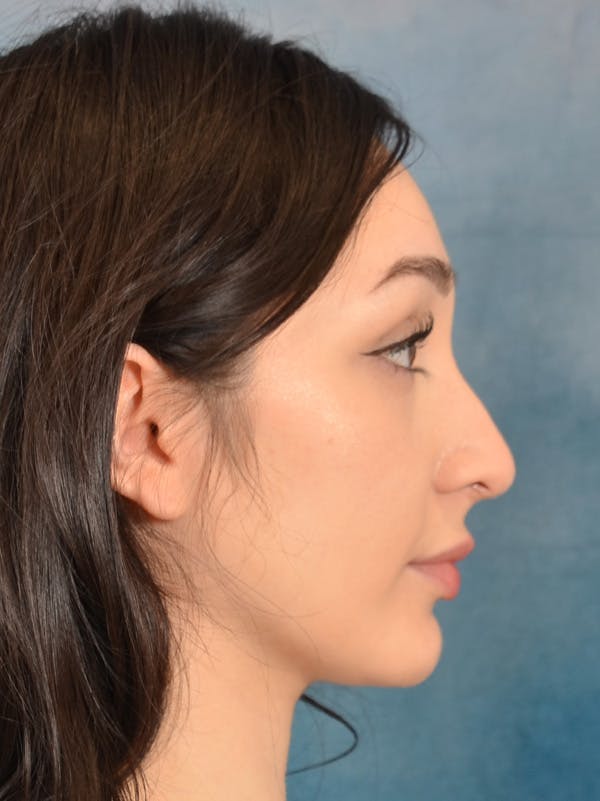 Rhinoplasty Before & After Gallery - Patient 286205 - Image 9