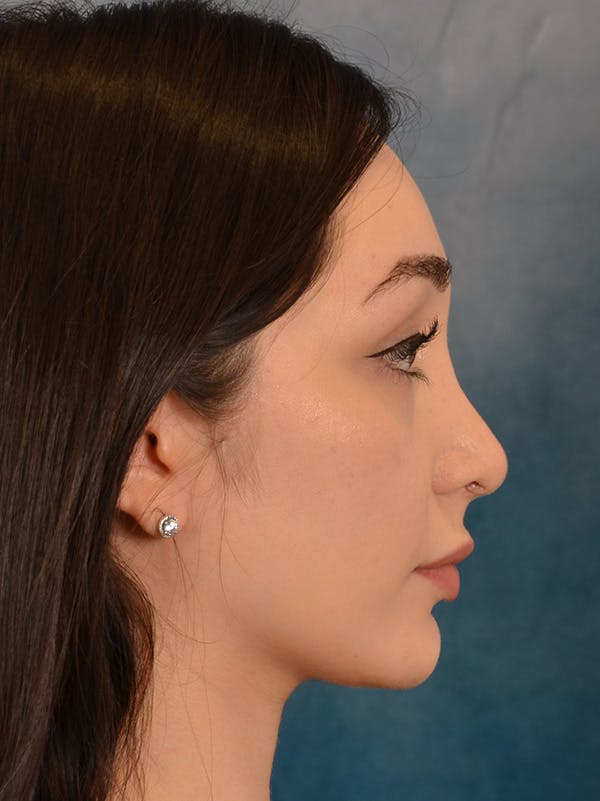 Rhinoplasty Before & After Gallery - Patient 286205 - Image 10