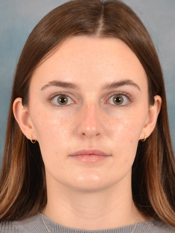 Rhinoplasty Before & After Gallery - Patient 302588 - Image 5