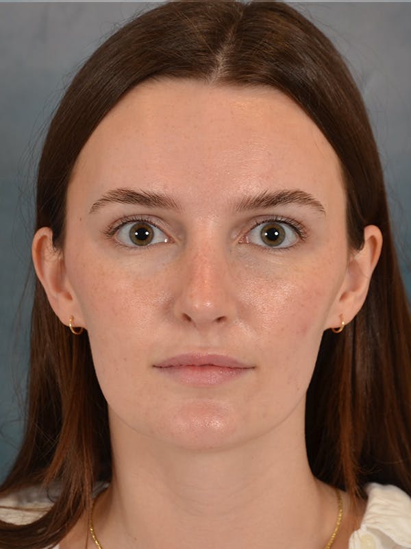 Rhinoplasty Before & After Gallery - Patient 302588 - Image 6