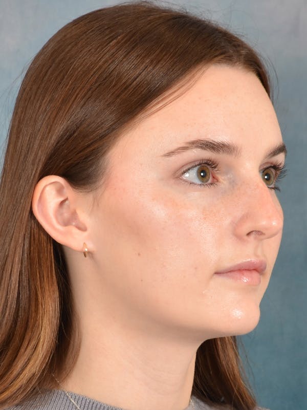 Rhinoplasty Before & After Gallery - Patient 302588 - Image 7