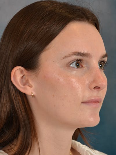 Rhinoplasty Before & After Gallery - Patient 302588 - Image 8