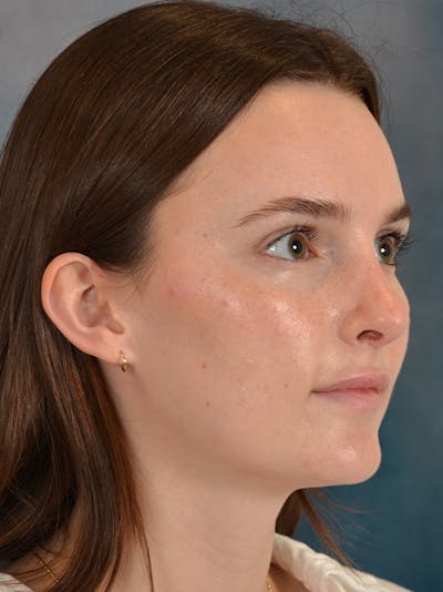 Rhinoplasty Before & After Gallery - Patient 302588 - Image 6