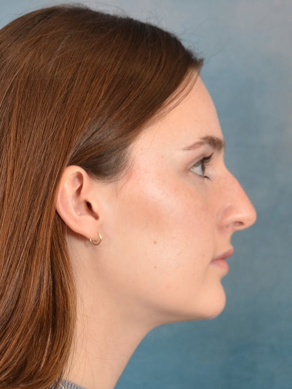 Rhinoplasty Before & After Gallery - Patient 302588 - Image 9