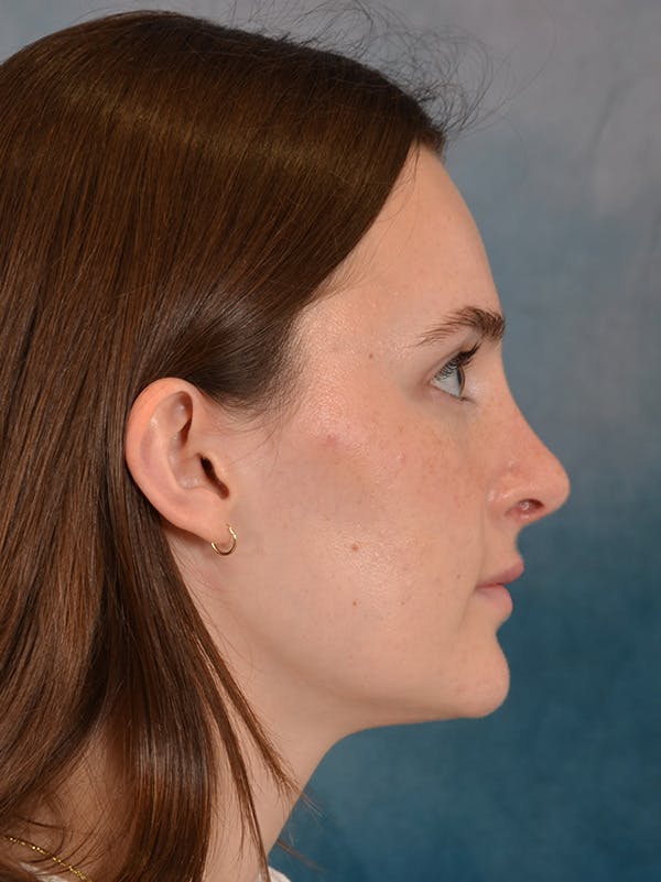 Rhinoplasty Before & After Gallery - Patient 302588 - Image 10
