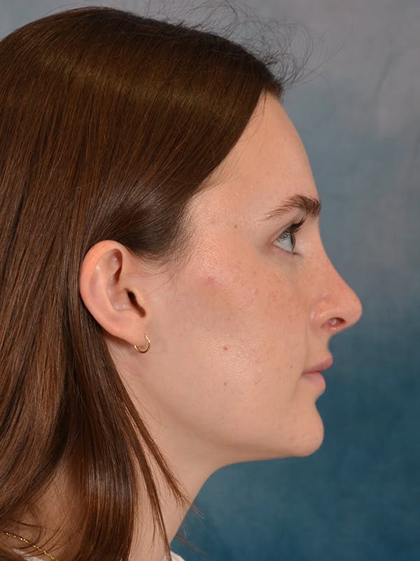 Rhinoplasty Before & After Gallery - Patient 302588 - Image 8