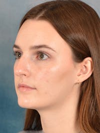 Rhinoplasty Before & After Gallery - Patient 302588 - Image 1