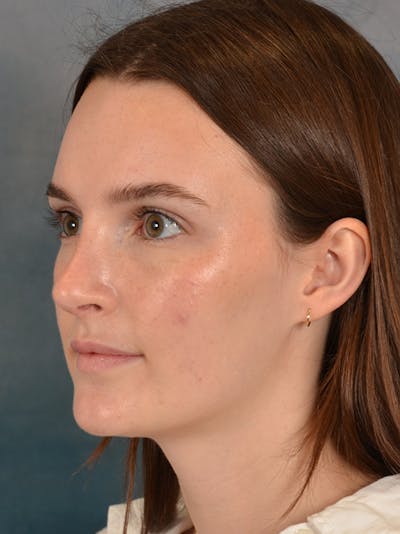 Rhinoplasty Before & After Gallery - Patient 302588 - Image 4