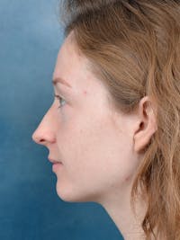 Rhinoplasty Before & After Gallery - Patient 355058 - Image 1
