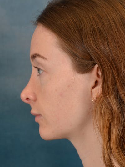 Rhinoplasty Before & After Gallery - Patient 355058 - Image 2