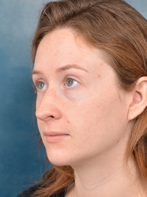 Rhinoplasty Before & After Gallery - Patient 355058 - Image 3
