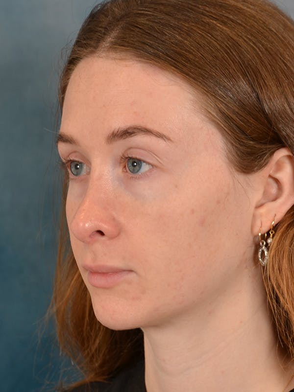 Rhinoplasty Before & After Gallery - Patient 355058 - Image 4