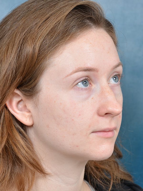Rhinoplasty Before & After Gallery - Patient 355058 - Image 7