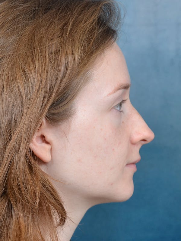 Rhinoplasty Before & After Gallery - Patient 355058 - Image 9