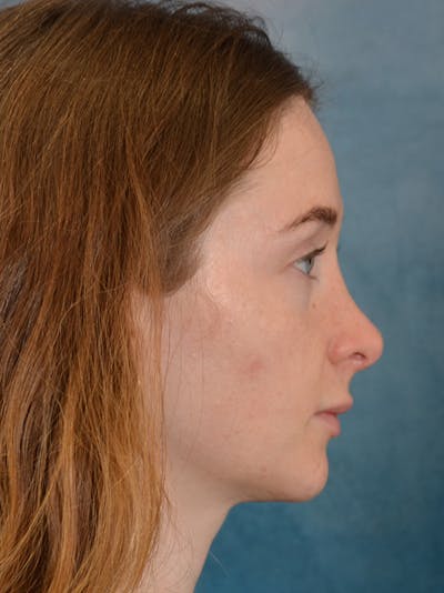Rhinoplasty Before & After Gallery - Patient 355058 - Image 10