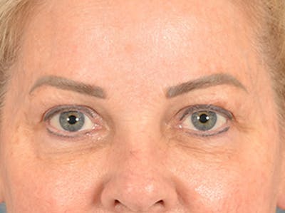 Eyelid Lift Before & After Gallery - Patient 256028 - Image 1
