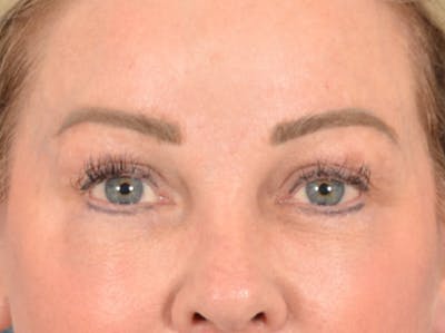 Brow Lift Before & After Gallery - Patient 146840 - Image 2