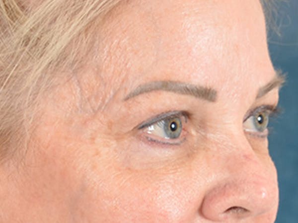 Eyelid Lift Before & After Gallery - Patient 256028 - Image 3