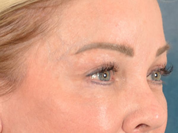 Eyelid Lift Before & After Gallery - Patient 256028 - Image 4