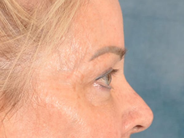 Brow Lift Before & After Gallery - Patient 146840 - Image 5