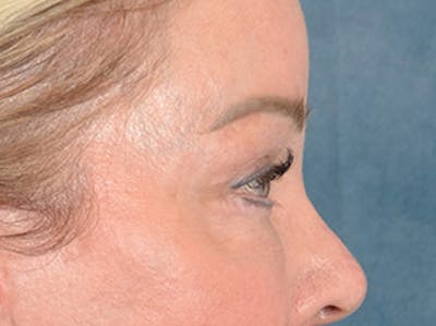 Eyelid Lift Before & After Gallery - Patient 256028 - Image 6