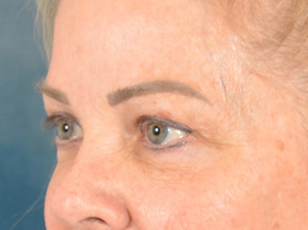 Brow Lift Before & After Gallery - Patient 146840 - Image 7