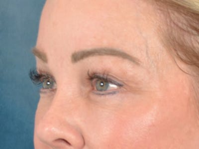 Eyelid Lift Before & After Gallery - Patient 256028 - Image 8