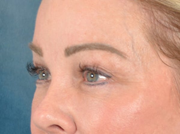 Eyelid Lift Before & After Gallery - Patient 256028 - Image 8