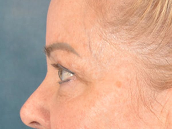 Eyelid Lift Before & After Gallery - Patient 256028 - Image 9